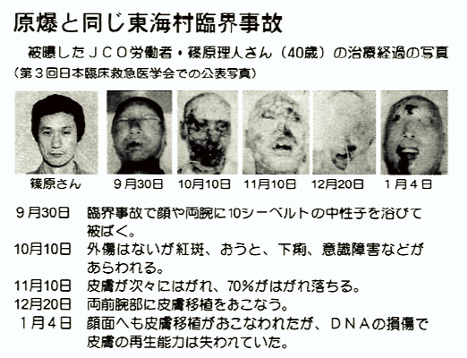 Хисаши Оучи: самая страшная жертва радиации в истории, оставшаяся в живых 83 дня против его воли! 5