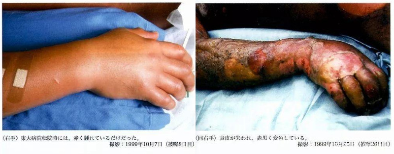 Hisashi Ouchi：历史上最严重的辐射受害者违背他的意愿活了 83 天！ 4