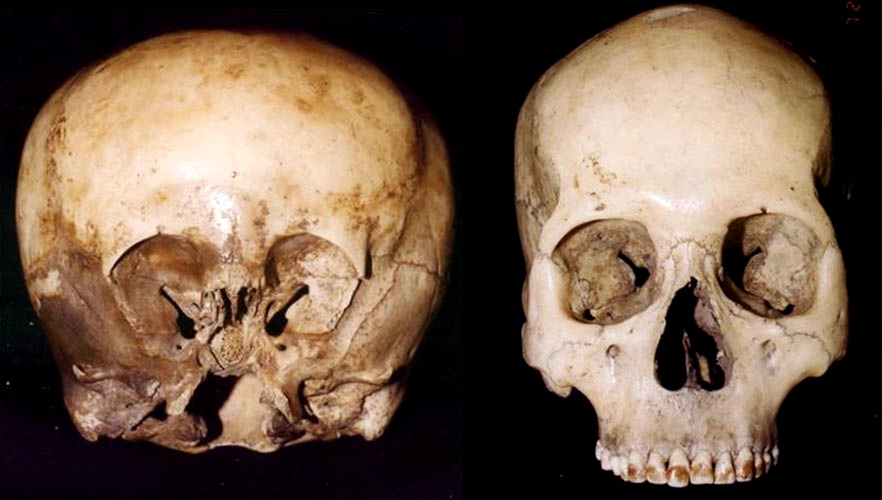 Мистериозниот череп на Starchild и потеклото на Star Children: Кои се тие? 11