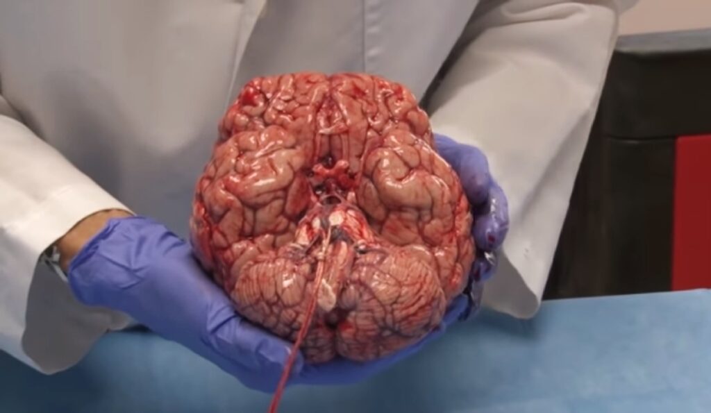 This video of a freshly removed human brain has fascinated the world 10
