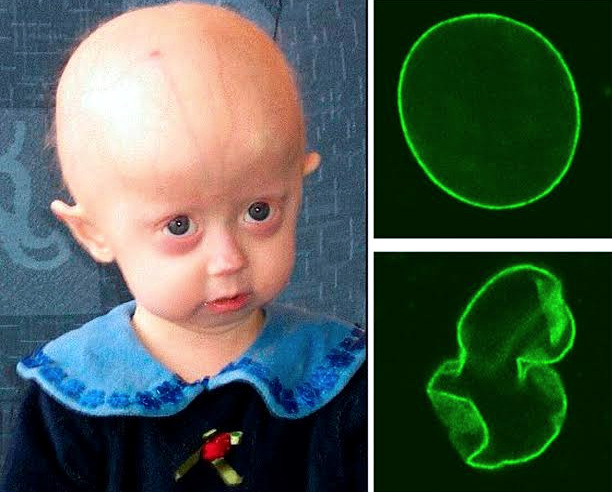 10 of the strangest rare diseases you won't believe are real 10