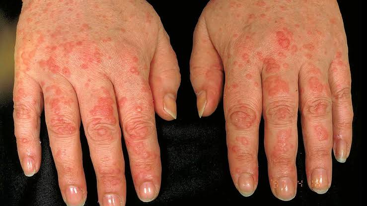 10 of the strangest rare diseases you won't believe are real 3
