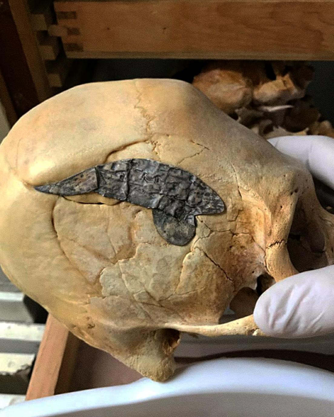 Peruansk långsträckt skalle som genomgick en skalloperation och fick metall kirurgiskt implanterad för att binda benen efter att ha skadats i strid för cirka 2,000  år sedan