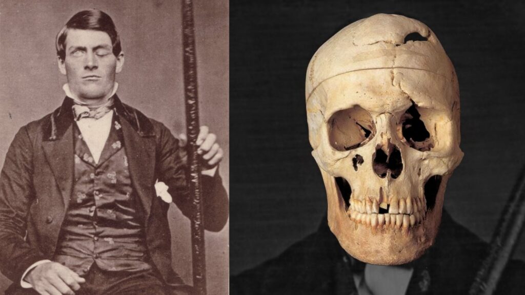 Phineas Gage — the man who lived after his brain was impaled with an iron rod! 1