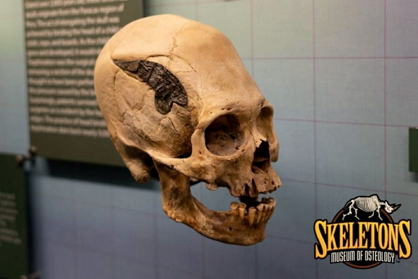 This skull from Peru has a metal implant. If it is authentic then it would be a potentially unique find from the ancient Andes.