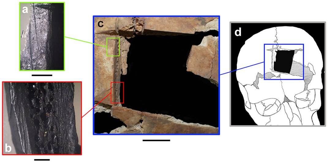 Arqueólogos descobrem vestígios iniciais de cirurgia cerebral no final da Idade do Bronze 2